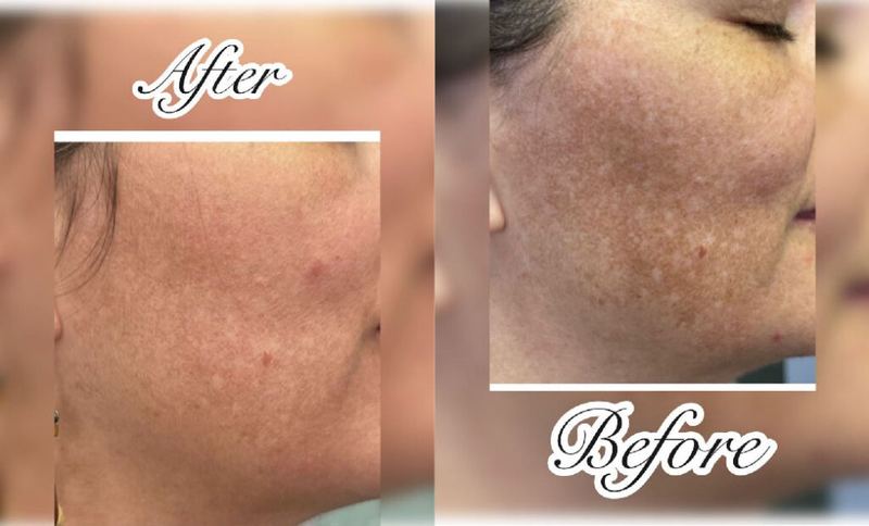 Before and after: pigmentation on cheek