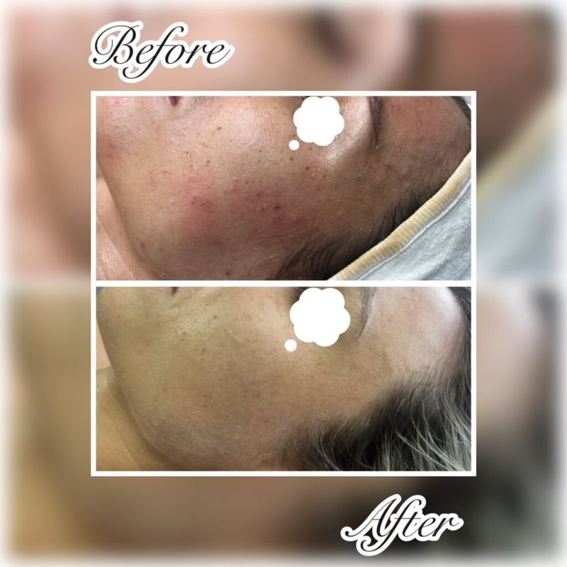 Before and after: acne scarring