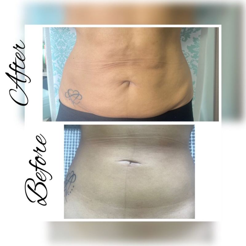 Before and after: abdomen